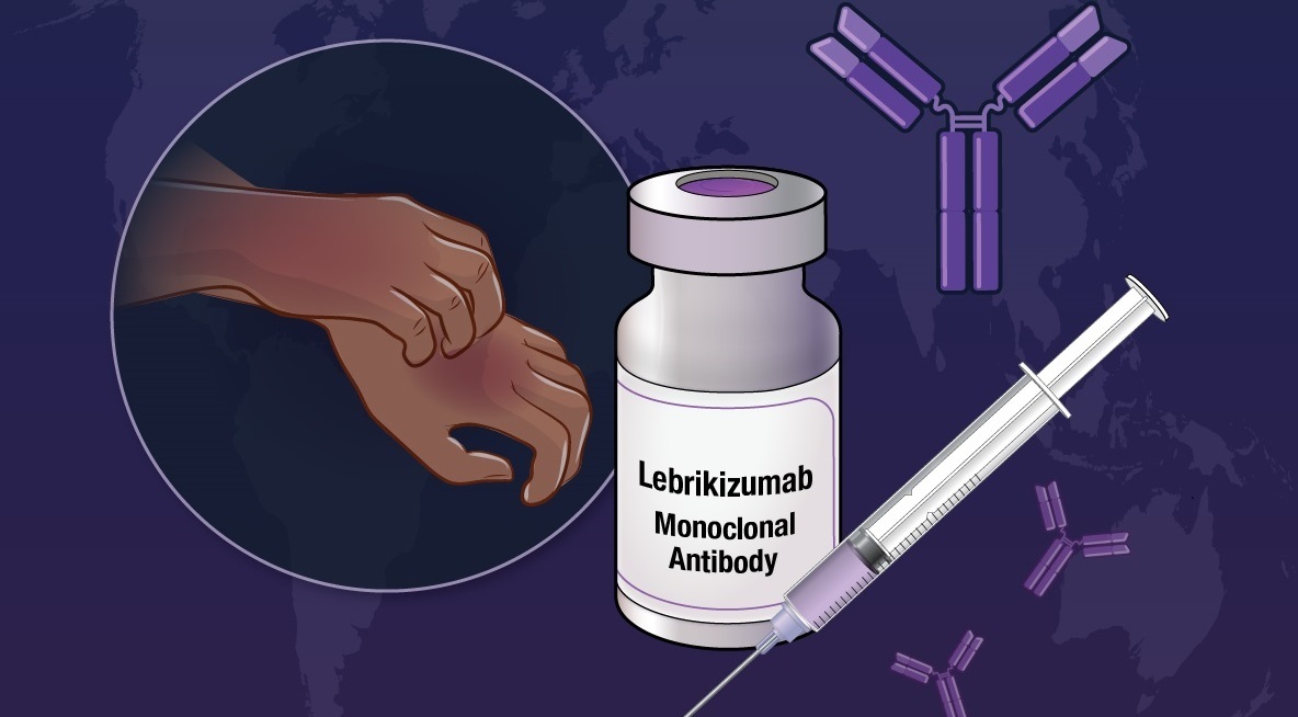 FDA Approves Lebrikizumab for Atopic Dermatitis